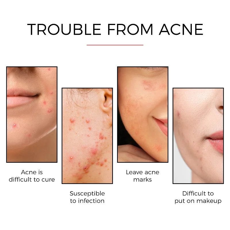 24pcs 얼굴 여드름 여드름 스팟 흉터 관리 치료 스 - Skincare Finally Found You 리뷰 및 가격